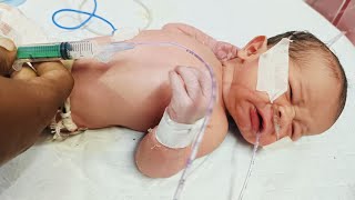 Ping An Ng Tube For Stomach Wash Gastric Lavage In Newborn Baby Step-By-Step Nicu Procedure