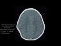 Depressed Skull Fracture