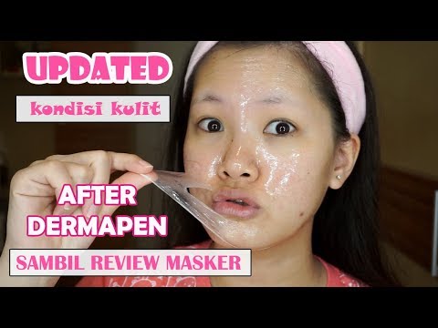 UPDATED! KONDISI KULIT Setelah Dermapen 1 Sambil Review Freeman Pomegranate Peel Off Gel Mask - YouTube