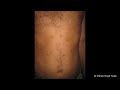 Chicken Pox- Diagnosis & Treatment
