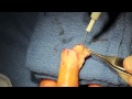 Amputation