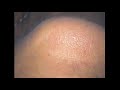 My Edited Video 1. Avoiding Needless Dental Implant Bridge Remakes - loose abutment screws