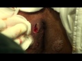 PERIANAL ABSCESS