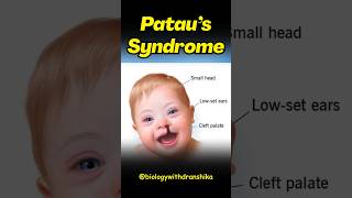 Pataus Syndrome Trisomy 13 Brings Major Challenges From Birth