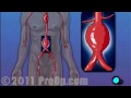 Abdominal Aortic Aneurysm Surgery PreOp® Patient Education