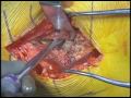 Anterior Hip Replacement Surgery