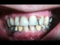 İmplant Diş Ameliyatı , Protez Diş yapımı , Bone splitting , Sinüs Lifting