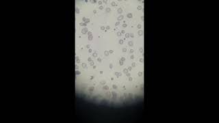 Microcytic Hypochromic Anemia- Anisopoikilocytosis