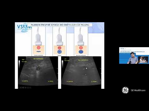 Siêu âm chẩn đoán huyết khối tĩnh mạch chi dưới Bs. Nguyễn Quang Trọng
