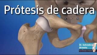 Prótesis de cadera