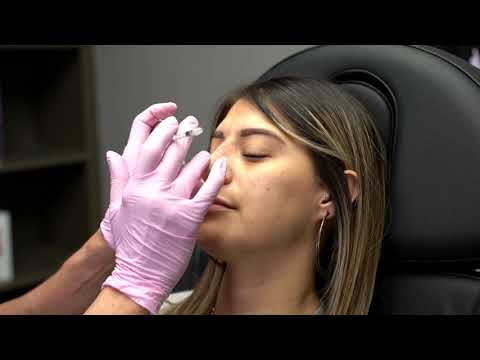 El Paso, TX | Rhinoplasty Filler Treatment | SkinSational MedSpa