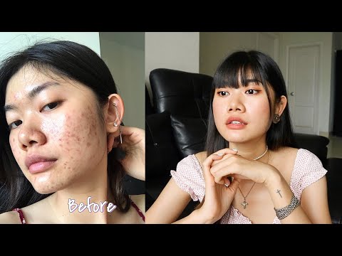 Mụn Ẩn, Mụn Nội Tiết. LÀM THẾ NÀO ĐỂ THOÁT MỤN MỘT CÁCH TỰ NHIÊN| My Acne Story