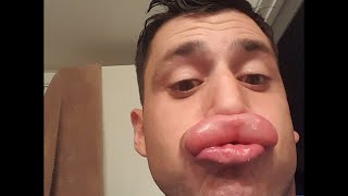 Guy Stung in Lip by Yellow Jackets Twice