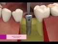 Dental implant procedure (Osstem implant TS III)