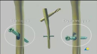 Enclouage Intramédullaire Avec Le Pfna