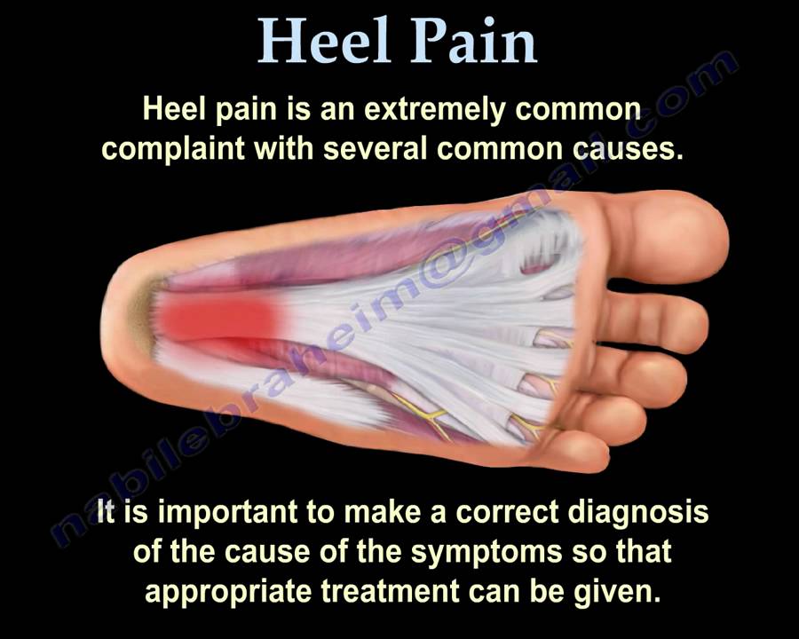 Heel Pain and plantar fascitis , Everything You Need To Know - Dr