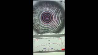 One Year Post Penetrating Keratoplasty For Advanced Keratoconus Kanellopoulos Md