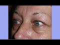 traitement poches yeux