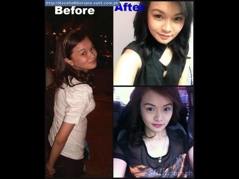 Most Effective Glutathione - for Acne Prone Skin