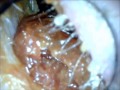 Ear wax removal. Another massive lump appears