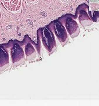 Histopathology Tongue - Squamous Cell Carcinoma