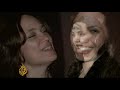 Jolie surgery shines spotlight on breast cancer