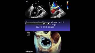 Posterior Mitral Valve Prolapse With Flail P2 Scallop 2D3D Image