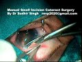 Manual Small Incision Cataract Surgery (SICS) By Dr Sudhir Singh