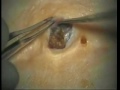 Huges Blackhead Removed Please Watch On Empty Stomach images Huges Blackhead Removed Please Watch On Empty Stomach