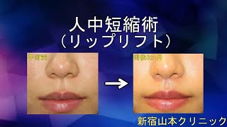 人中短縮術(リップリフト、上口唇短縮術)を写真でわかりやすく解説