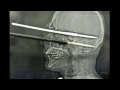 X-ray pics: Man shoots himself in the face with a harpoon in Brazil...and survives!