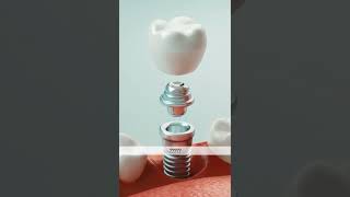 Aesthetica Veda Dental Implants Dr Parikh Gowda