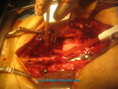 El servicio de socorro de la osteocondrosis