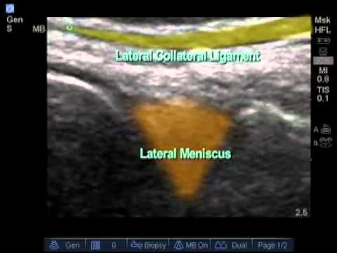 How to: Lateral Meniscus Ultrasound Exam - YouTube