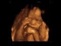 ultrasound 3d 4d