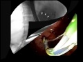 Large bile duct stone removal case study, D. Adler MD Large bile duct stone removal case study, D. Adler MD