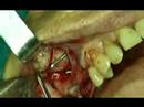implant dental video preview 05