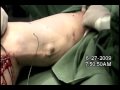 safenectomia
