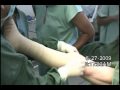 safenectomia