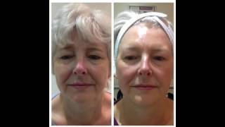 Coolifting Before/After