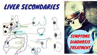 Cancer Metastasis In The Liver Symptoms Diagnosis Treatment