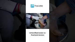 Psoriasis Lesions Vs Lichenified Lesions