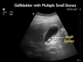 Gallblader Ultrasound - Gallstones - SonoSite, Inc.
