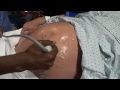 External Cephelic Version Procedure on a Breech Baby