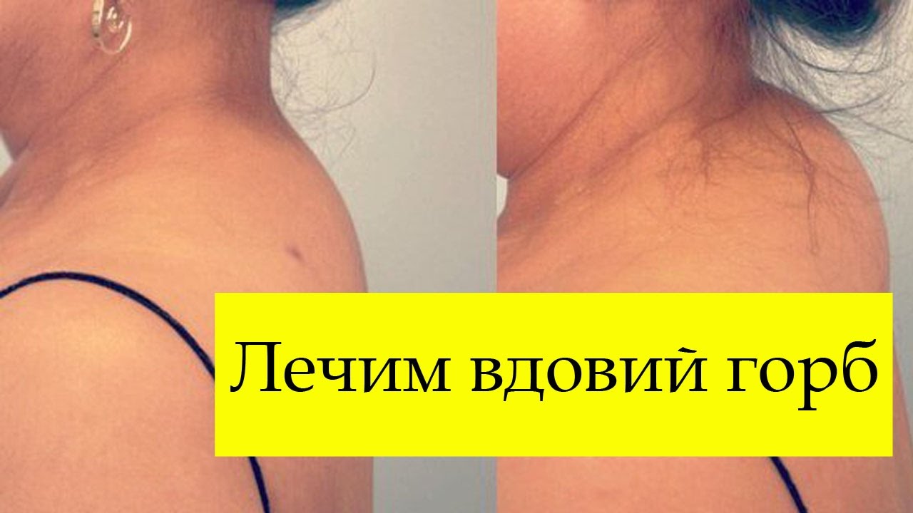 Как убрать вдовий горб в домашних условиях Как убрать вдовий горб в домашних условиях