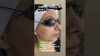Chemical Peeling For Acnepimples