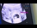 USG untuk Pemeriksaan Kehamilan 2 Bulan ~ DOKTER OZ INDONESIA 26 Februari 2017 USG untuk Pemeriksaan Kehamilan 2 Bulan ~ DOKTER OZ INDONESIA 26 Februari 2017