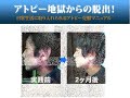 アトピーの治し方〜自宅でできるアトピー根本対策方法