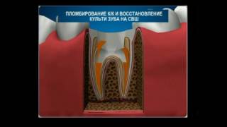 Стекловолоконный штифт в лечении зубов Стекловолоконный штифт в лечении зубов