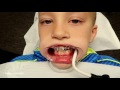David Gets BRACES!!!!